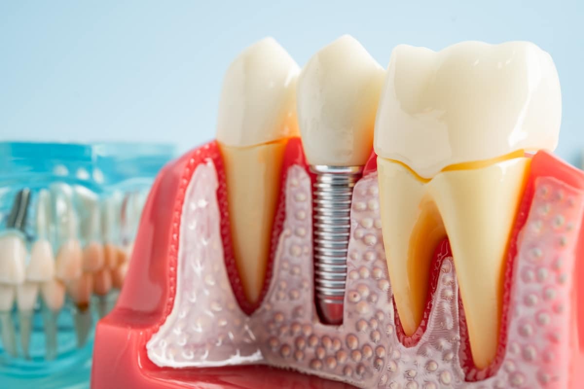 Dental Implants in Waukegan, IL: Everything You Need to Know Before Restoring Your Smile
